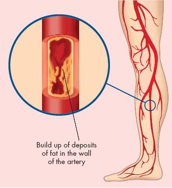 Ảnh 3 của Peripheral arterial disease